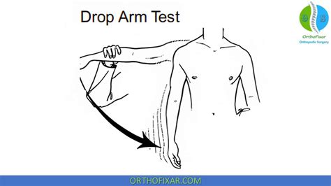 drop arm testing|drop arm test positive means.